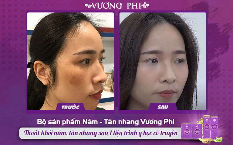 Chị Thanh Thảo tin tưởng lựa chọn Vương Phi để điều trị nám sạm sau sinh