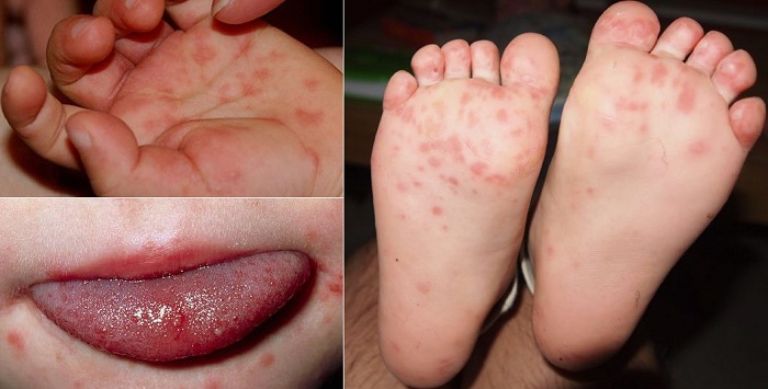 Chân tay miệng là một bệnh truyền nhiễm thường gặp ở trẻ nhỏ