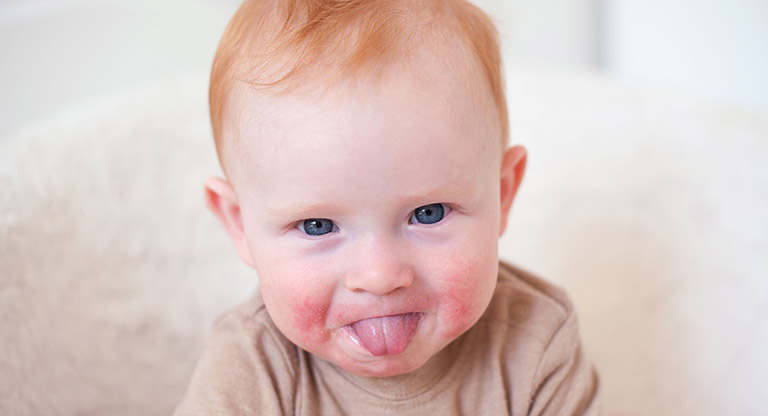 Nấm miệng là bệnh lý thường gặp ở trẻ em