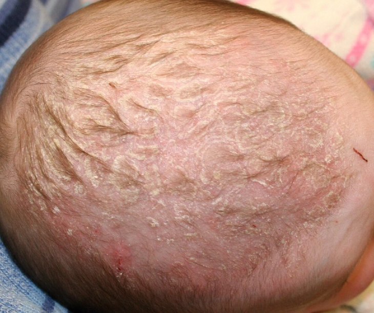 Bệnh vảy nến da đầu thường gặp ở trẻ sơ sinh