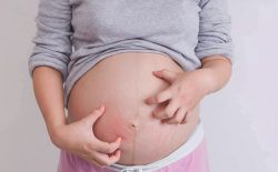 Nổi mề đay khi mang thai – Mẹ bầu cần hiểu đúng, ghi nhớ cách chữa an toàn