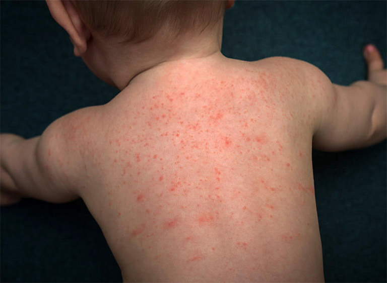 Nổi mẩn đỏ ngứa ở lưng có thể là triệu chứng của các bệnh về da liễu