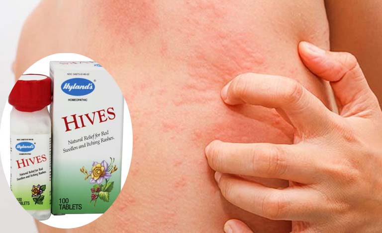 Thuốc Hives có tác dụng hỗ trợ cải thiện triệu chứng ngứa ngáy khó chịu