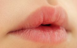 Nổi mề đay sưng môi: Hiểu đúng bản chất, tránh biến chứng sau này