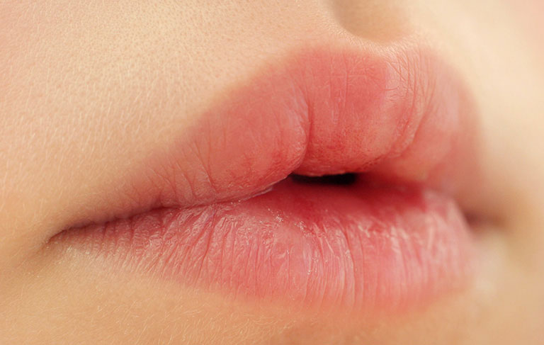 Nổi mề đay sưng môi: Hiểu đúng bản chất, tránh biến chứng sau này