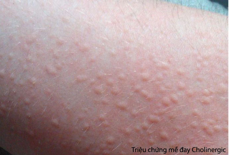 Khi bị mày đay cholinergic làn da sẽ bị nổi các nốt ban đỏ