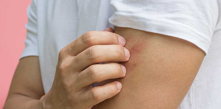 Nổi mẩn đỏ như muỗi đốt có thể do bạn bị dị ứng hoặc do mắc một số bệnh lý khác