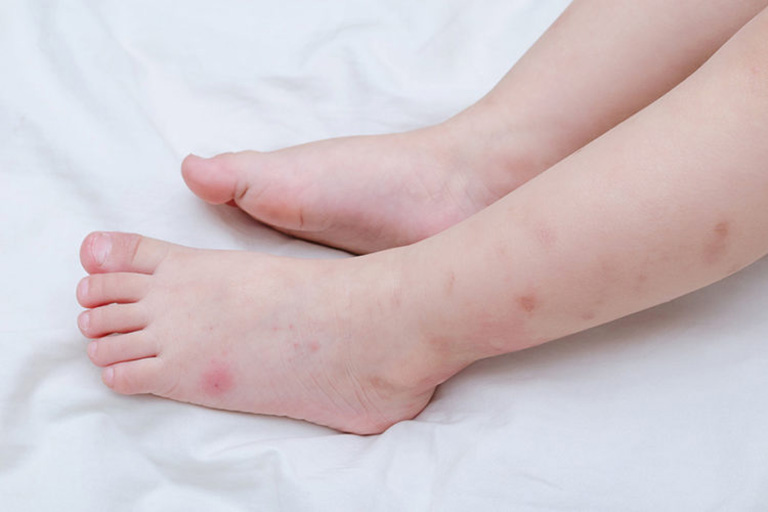 Nổi mẩn đổ như muỗi đốt là hiện tượng của bệnh lý về da
