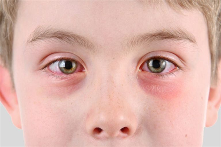 Bị nổi mẩn đỏ quanh mắt: Tìm hiểu nguyên nhân, điều trị dứt điểm