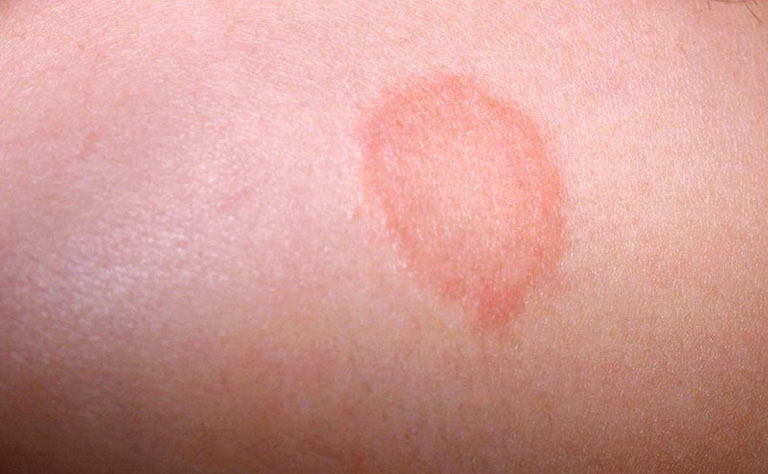 Nổi mẩn đỏ ngứa như muỗi đốt có thể là triệu chứng của bệnh hắc lào