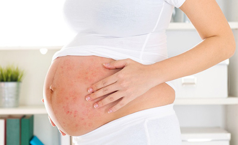 Phụ nữ khi mới mang thai thường rất nhạy cảm và rất dễ bị nổi mề đay, mẩn ngứa