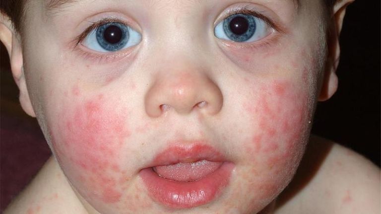 Bệnh chàm ở trẻ sơ sinh có dấu hiệu nổi mẩn đỏ trên da