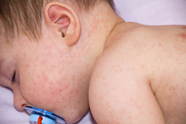 Trẻ phát ban đỏ nhưng không sốt có thể do bị chàm sữa, viêm da cơ địa hoặc một số bệnh lý khác