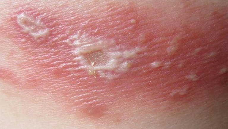 Viêm da tiếp xúc kích ứng là bệnh lý do da bị ma sát hoặc tiếp xúc với các hóa chất