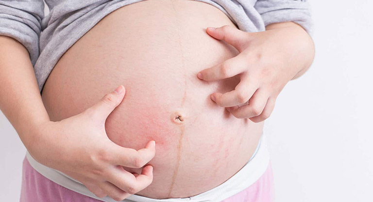Kích thước của thai nhi lớn từng ngày gây thay đổi cấu trúc da