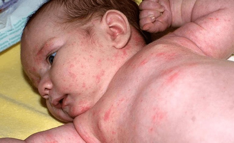 Bé bị sốt xuất huyết thường có triệu chứng nổi mẩn đỏ sau sốt