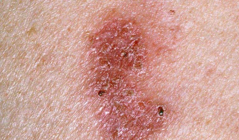 Người ung thư da thường nổi mẩn đỏ ở lưng không ngứa