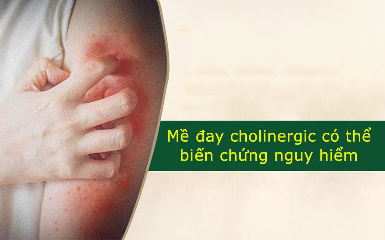Mề đay cholinergic dễ tái phát và gây biến chứng nguy hiểm