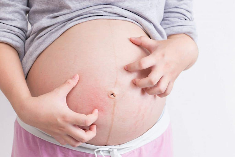 Bà bầu bị nổi mẩn đỏ ở bụng không ngứa thường xuất hiện vào giai đoạn cuối của thai kỳ