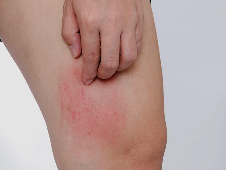 Nổi mẩn đỏ ngứa ở chân là bị bệnh gì? Cách điều trị dứt điểm