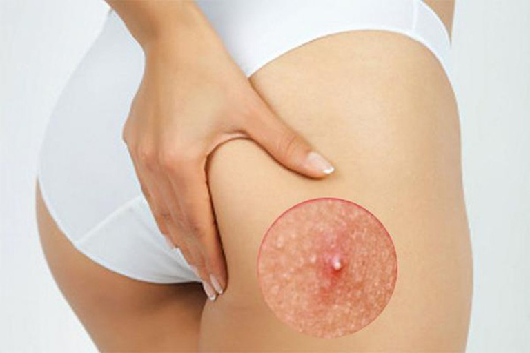 Cơ thể bị nấm xâm nhập có thể gây nổi mẩn đỏ ngứa ở mông