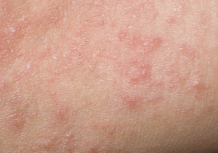 Nổi mẩn đỏ ở lưng không ngứa là biểu hiện của bệnh viêm da tiếp xúc