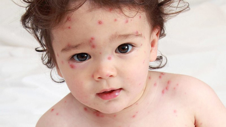 Trẻ bị sốt nổi mẩn đỏ ngứa cũng có thể là dấu hiệu của bệnh thủy đậu