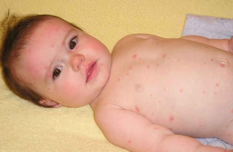 Mề đay cũng là một trong những nguyên nhân phổ biến khiến trẻ sơ sinh bị nổi mẩn đỏ ở mặt