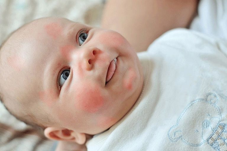 Trẻ sơ sinh có sức đề kháng và hệ miễn dịch yếu nên dễ bị nhiễm nấm Candida