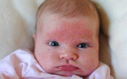 Phương pháp điều trị trẻ sơ sinh bị nổi mẩn đỏ ở mặt