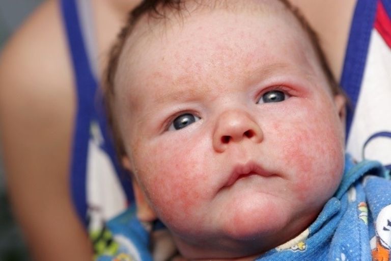 Khi bị virus, vi khuẩn tấn công, trẻ sơ sinh rất dễ bị nhiễm trùng da
