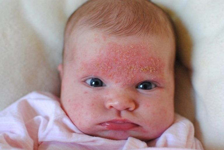 Phương pháp điều trị trẻ sơ sinh bị nổi mẩn đỏ ở mặt