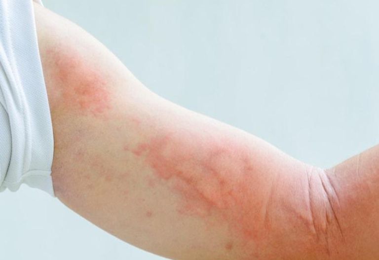 Nổi mẩn đỏ ngứa sau khi tắm có thể là triệu chứng của viêm da tiếp xúc