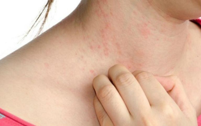 Viêm da tiếp xúc với triệu chứng đặc trưng là nổi mẩn đỏ ở nhiều vị trí trên cơ thể
