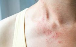 Trị Eczema bằng rau sam an toàn hiệu quả
