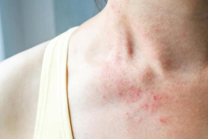 Trị Eczema bằng rau sam an toàn hiệu quả
