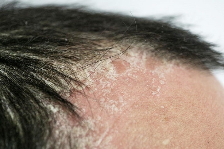 Vẩy nến da đầu: Dấu hiệu nhận biết và hướng điều trị