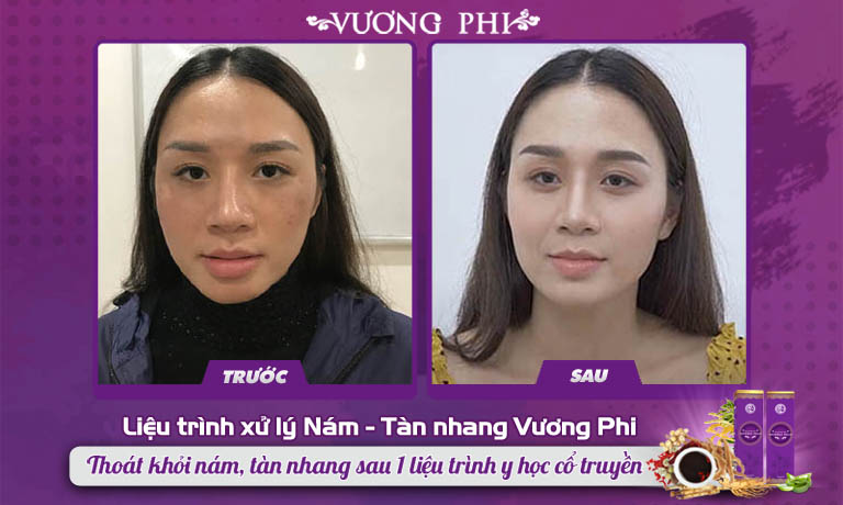 Chị Thu Hương (30 tuổi) cải thiện 80% nám, tàn nhang sau sinh chỉ sau 2 tháng