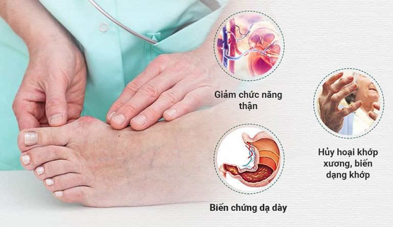 Gout gây biến chứng nguy hiểm nếu không điều trị kịp thời