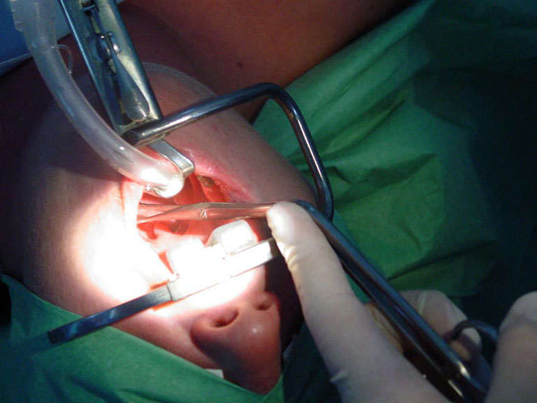 Phẫu thuật cắt amidan sẽ được bác sĩ cân nhắc chỉ định thực hiện khi bệnh diễn biến nghiêm trọng, không đáp ứng điều trị nội khoa