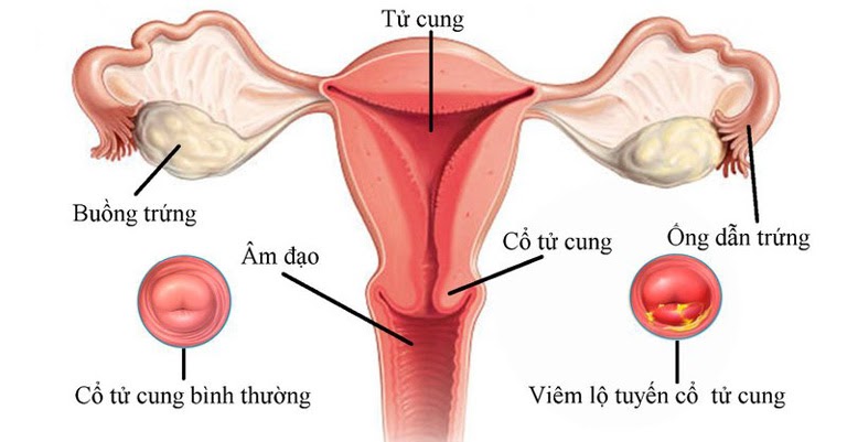 Viêm lộ tuyến cổ tử cung là một bệnh phụ khoa phổ biến