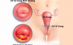 Hình ảnh viêm cổ tử cung ở phụ nữ 