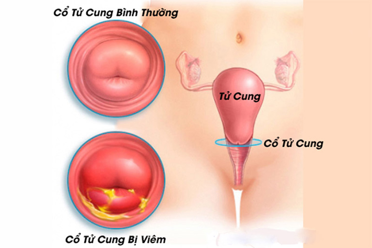 Hình ảnh viêm cổ tử cung ở phụ nữ 