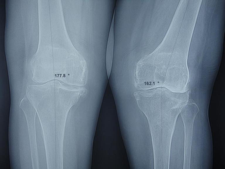  Hình ảnh X - quang của người bị thoái hóa khớp gối ở dạng nặng