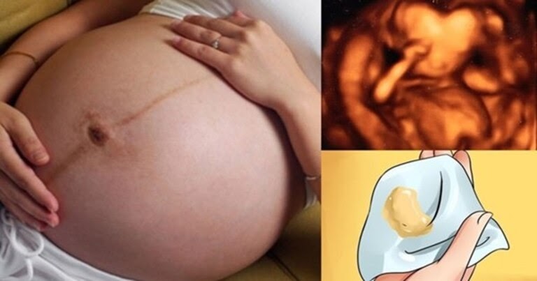 Nấm âm đạo cực kỳ phổ biến trong giai đoạn thai kỳ của phụ nữ