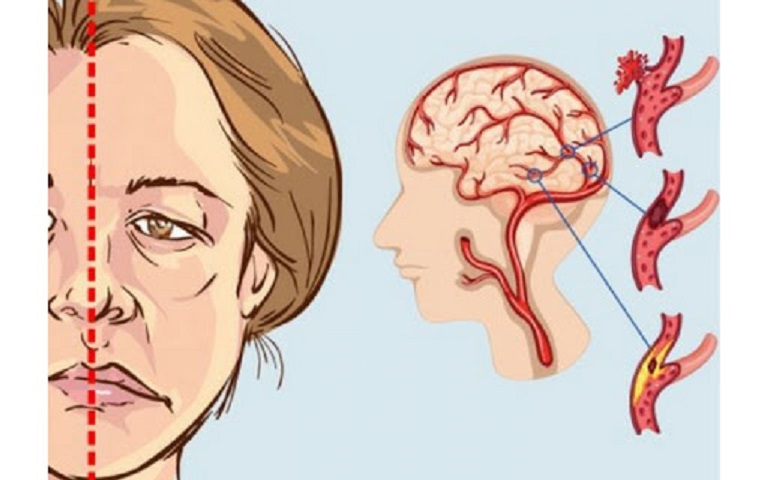 Liệt dây thần kinh số 7 là bệnh không lây truyền, có thể gặp ở bất cứ độ tuổi nào và không phân biệt giới tính.