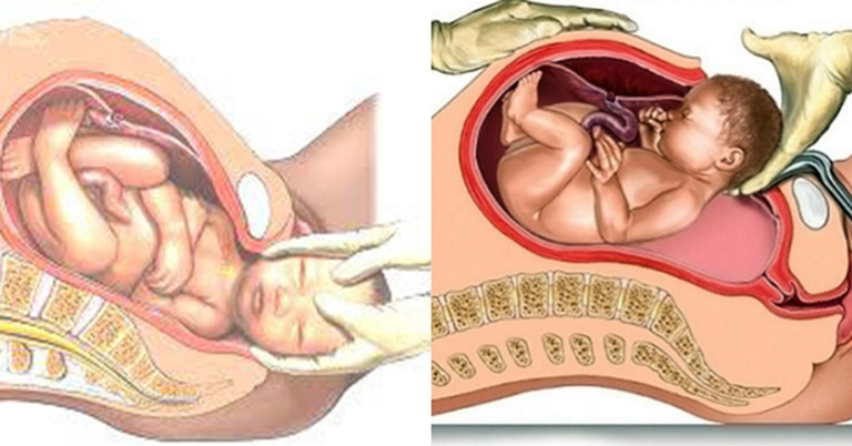 Cổ tử cung phải co giãn cực độ trong quá trình sinh thường