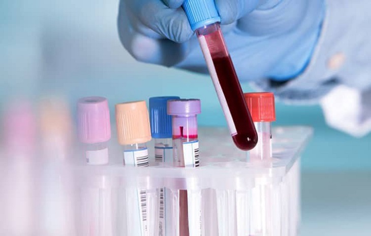 Xét nghiệm máu là phương pháp chẩn đoán sỏi niệu quản