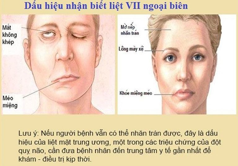 Triệu chứng điển hình của nhóm liệt dây thần kinh 7 ngoại biên