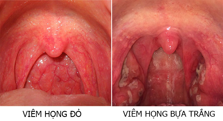 Triệu chứng tại chỗ của viêm họng đỏ và viêm họng bựa trắng (viêm họng do liên cầu)